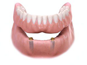 implant-supported-overdenture-300x225