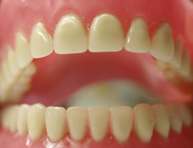 dentures-model