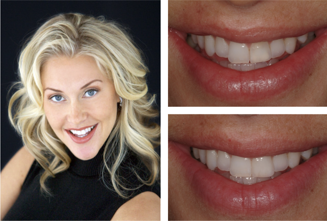 Blonde Woman Before and After Smile