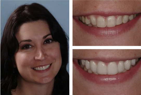 Brunette Woman Before and After Smile