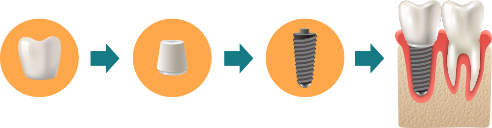 Crown Abutement Screw Process