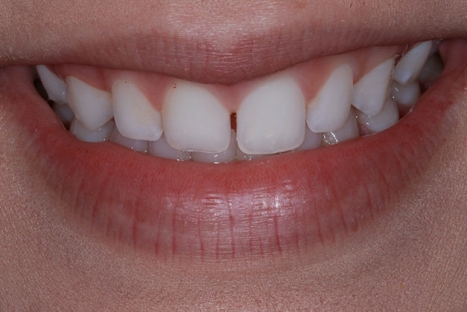 Dental Bonding - Before and After at Preventive Dentistry Braddon