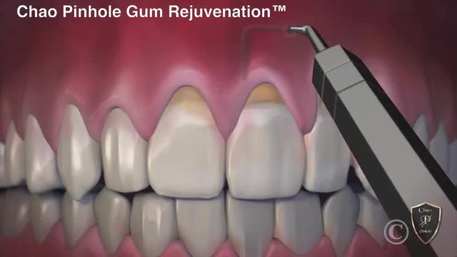 Cary Gum Contouring Raleigh Crown Lengthening Stanley Dentistry